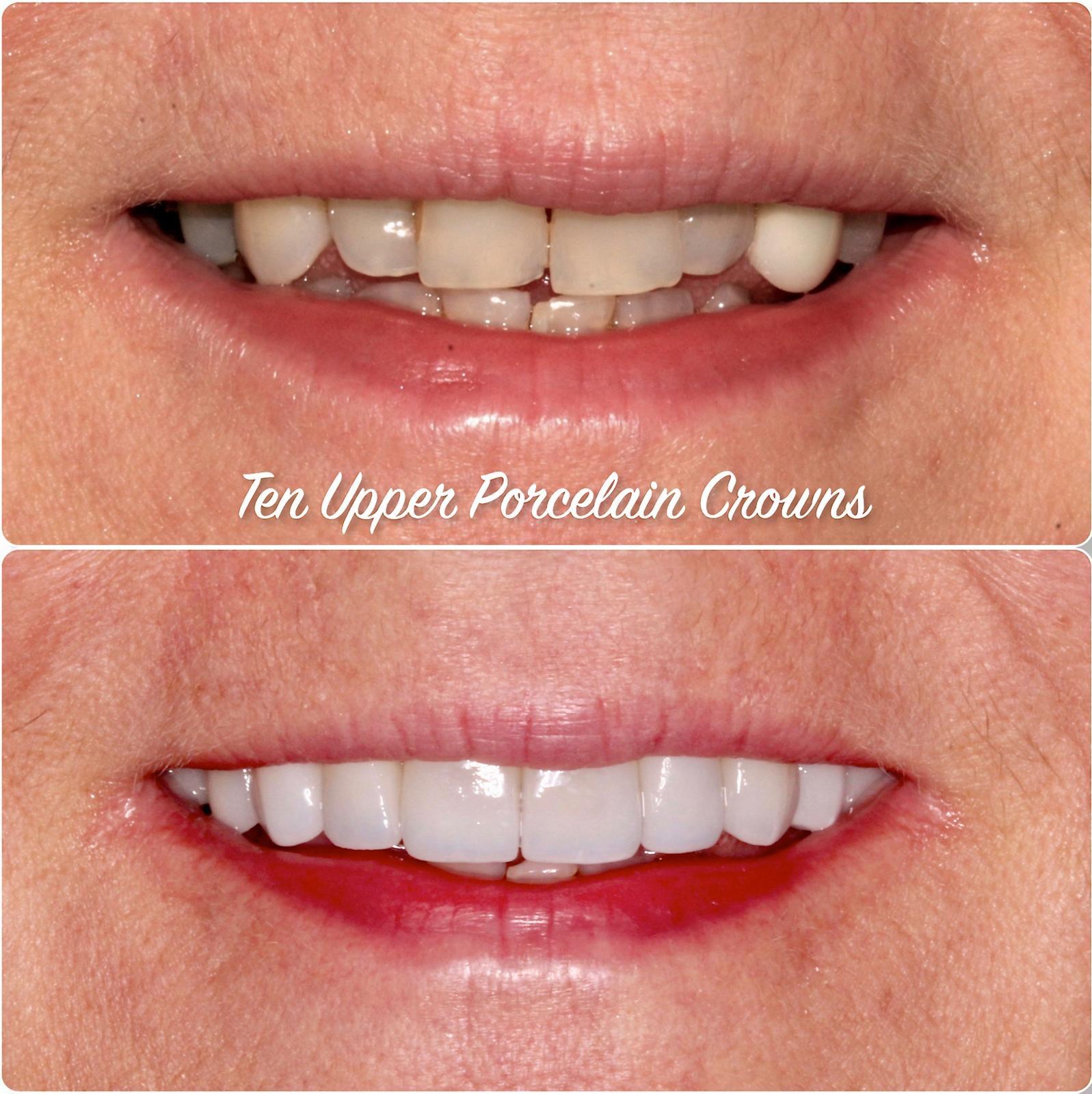 A complete smile transformation in just weeksWe enhanced this smile using ten upper porcelain crowns to correct crowding and restore a bright, even appearance.Treatment time:Completed in just 3 weeks across 2 appointments.