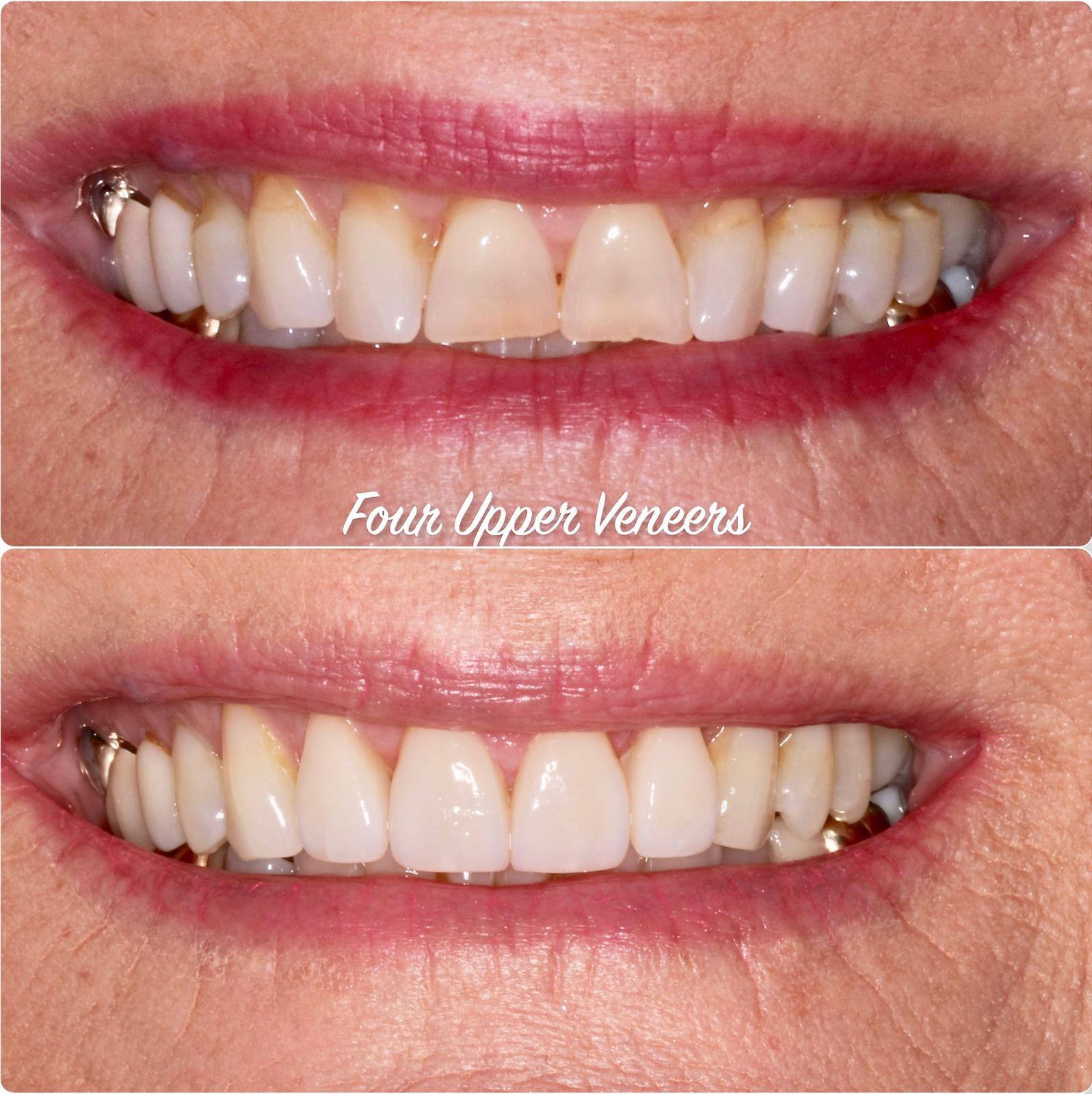 Straight-looking teeth without orthodonticsMinor misalignment was corrected using four upper veneers, creating a straighter, more harmonious smile in a single visit.Treatment timeCompleted in one appointment (approximately 2 hours).