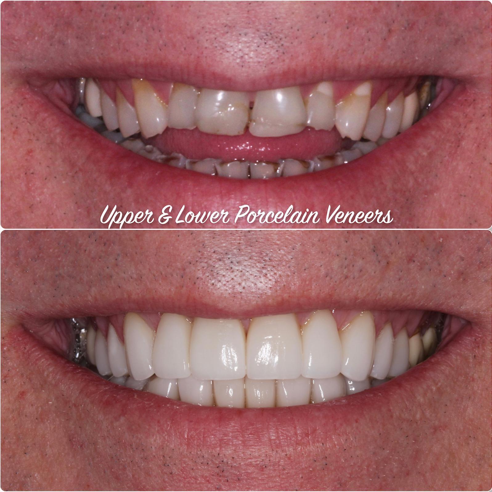 Comprehensive smile rehabilitationFor patients with heavily restored teeth and bite issues, we combine orthodontic treatment with full-mouth veneers to achieve long-lasting function and aesthetics.Treatment timePersonalised plan ranging from 1 to 5 years.
