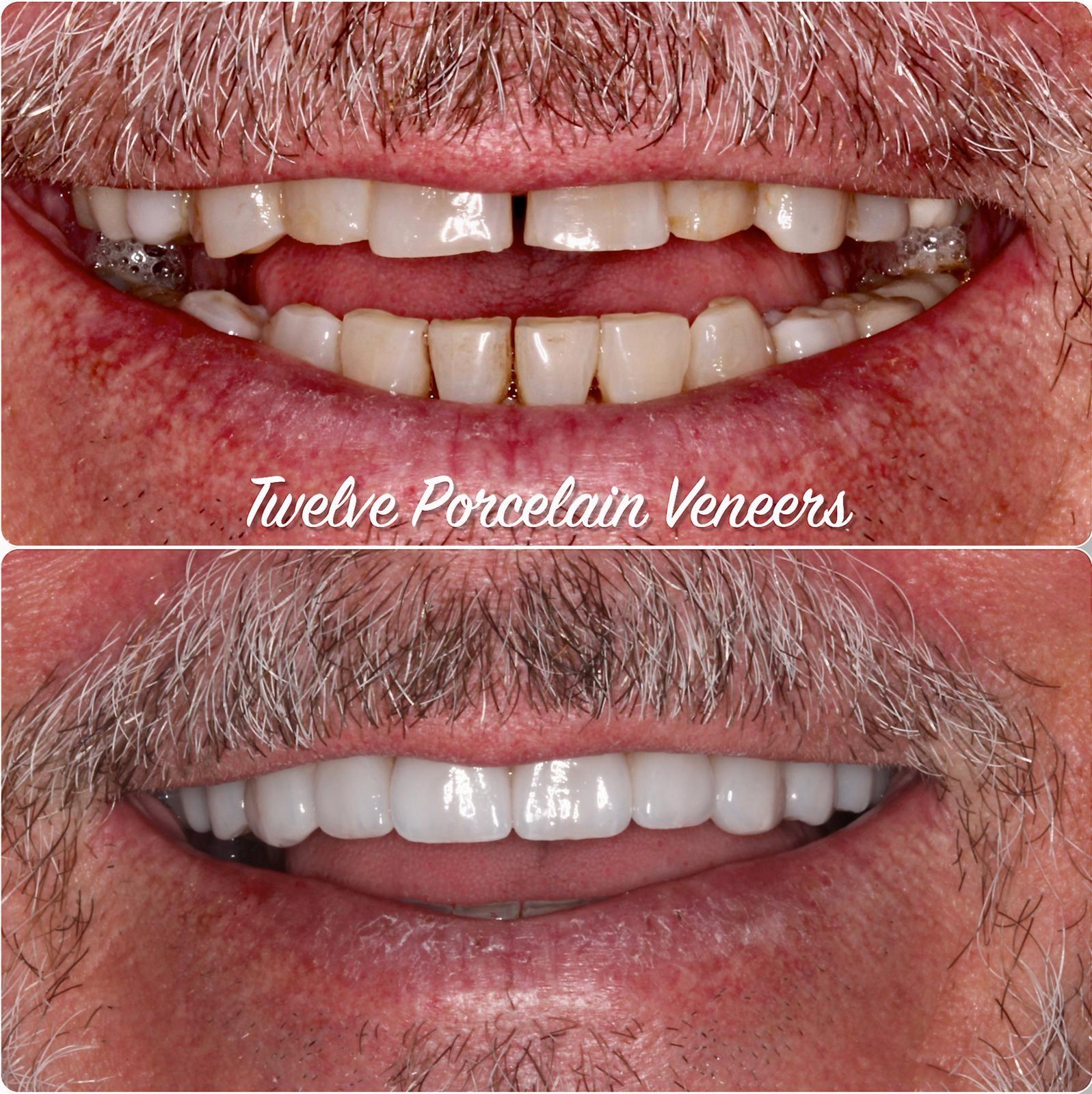 Restoring shape, strength, and brightnessWorn and uneven teeth were revitalised with twelve porcelain veneers, complemented by professional Zoom whitening for a fresh, youthful finish.Treatment time3 weeks, 2 appointments.