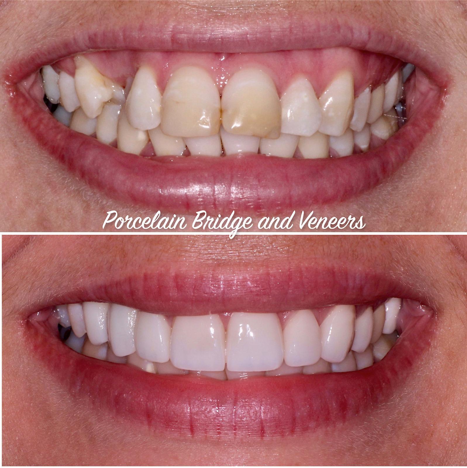 Rebuilding your smile seamlesslyMissing and discoloured teeth were restored using a combination of crowns, bridges, and veneers for a complete, natural-looking result.Treatment time2 appointments over 3 weeks.