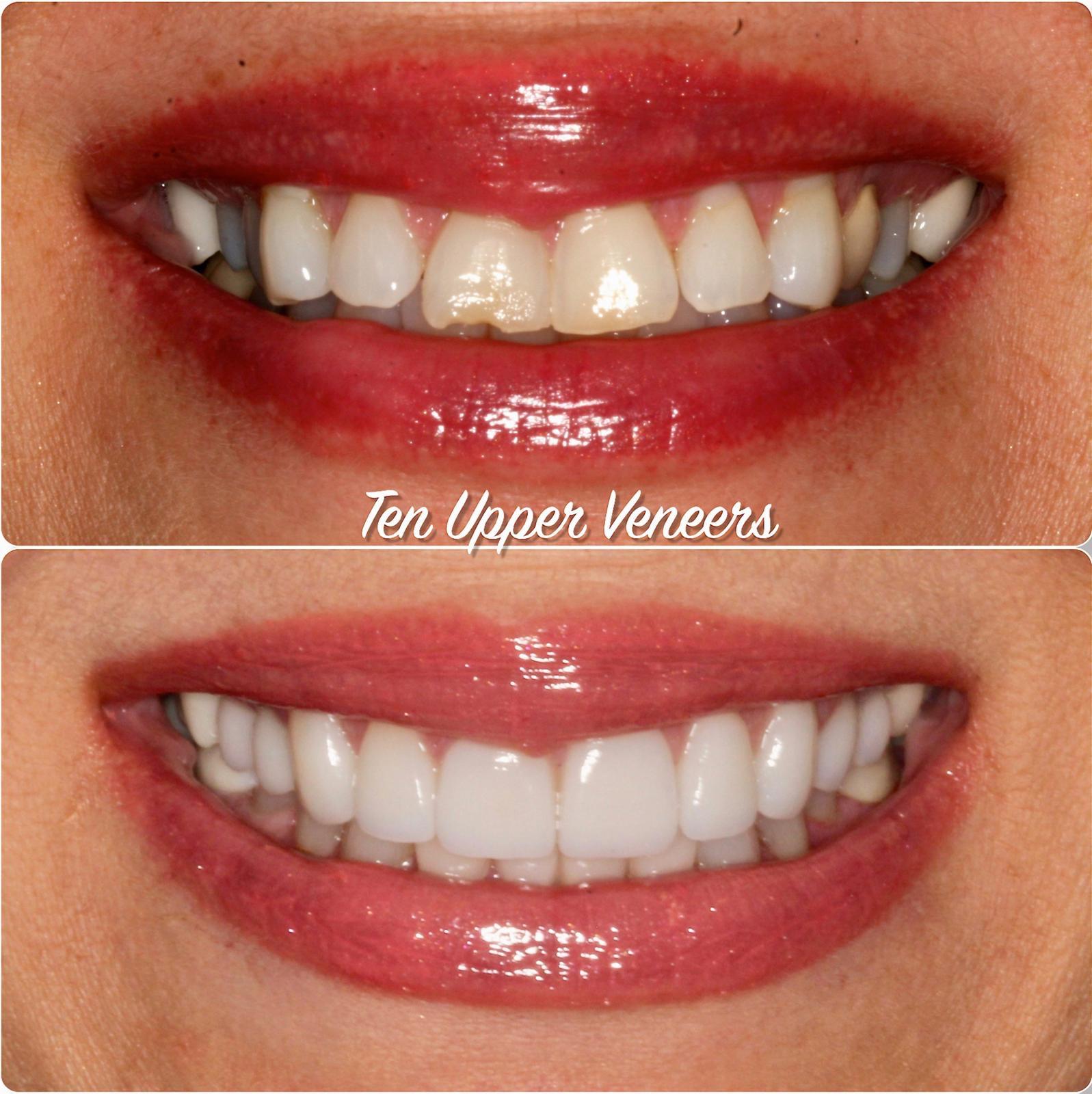 A straighter, brighter smile makeoverTen upper veneers were used to correct alignment, paired with lower teeth whitening to achieve a balanced, radiant smile.Treatment time2 appointments over 3 weeks.