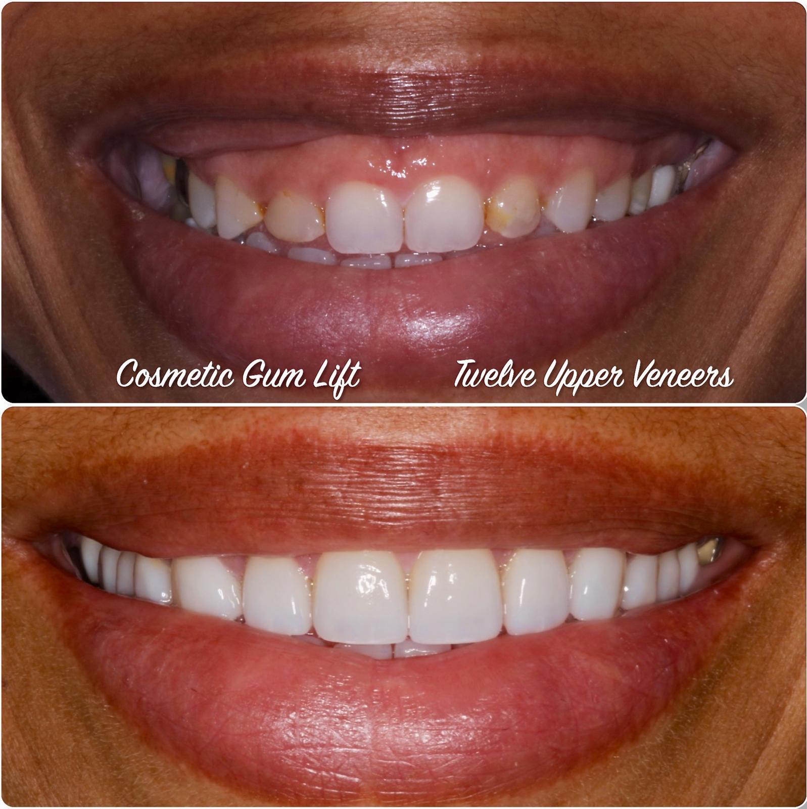 3 appointments over 3 weeks.A cosmetic laser gum lift was performed to reshape the gum line, followed by twelve upper veneers to create ideal proportions and a natural-looking smile.Treatment time3 appointments over 3 weeks.